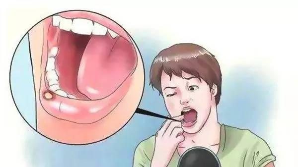 口腔溃疡出现这些症状，小心是口腔癌！