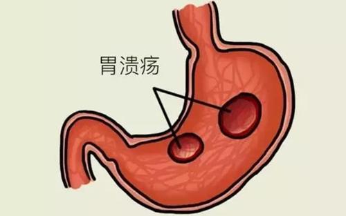 胃溃疡的常见症状有哪些？这些症状你了解吗？