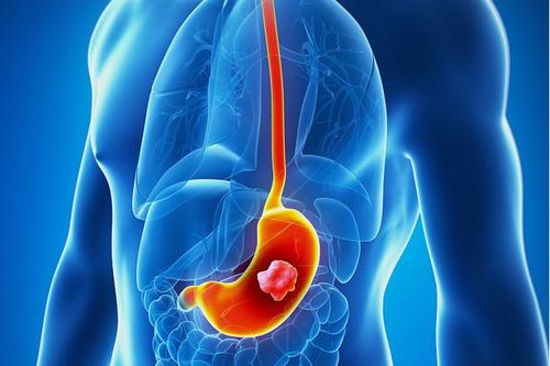 胃癌的病因是什么