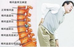 腰肌劳损的原因、症状与治疗方法