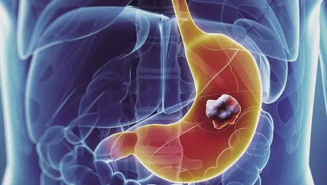 胃癌的早期症状有哪些？出现这些症状的要注意了！